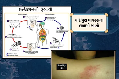 સાબરકાંઠામાં ચાંદીપુરા વાયરસથી વધુ એક મોત  કુલ મૃત્યુઆંક પાંચ થયો